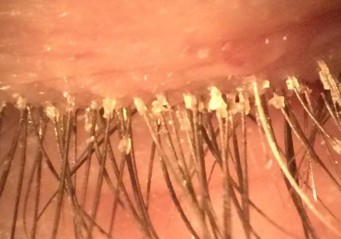 Blepharitis - Fairlawn Eye Care Blepharitis
