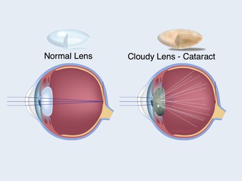 Cataracts