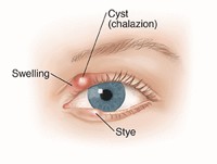 Chalazion
