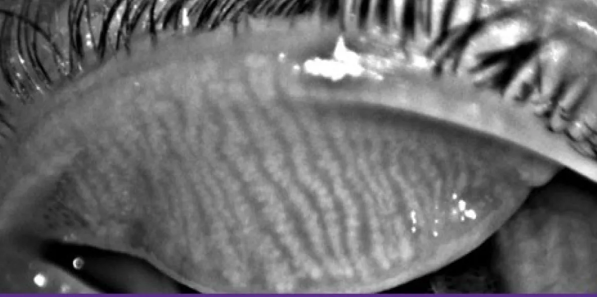 Close-up image of eyelid showing tear film pattern during exam