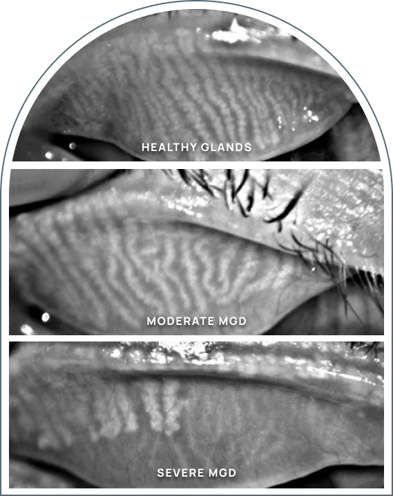 Comparison of healthy and diseased meibomian glands