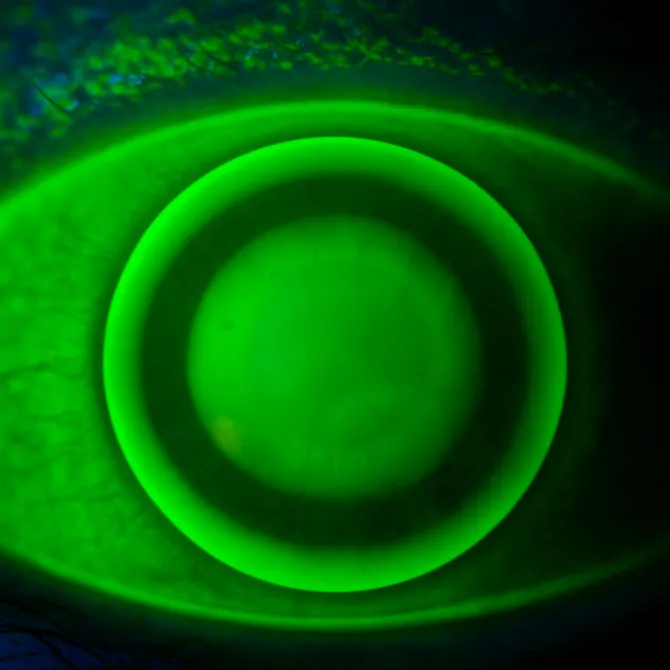Fluorescein eye image showing contact lens fit and alignment
