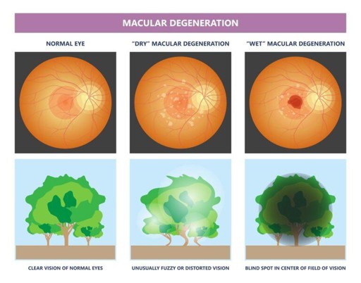 Macular Degeneration - Fairlawn Eye Care Macular Degeneration