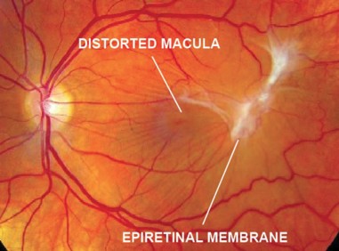 Macular Pucker - Fairlawn Eye Care