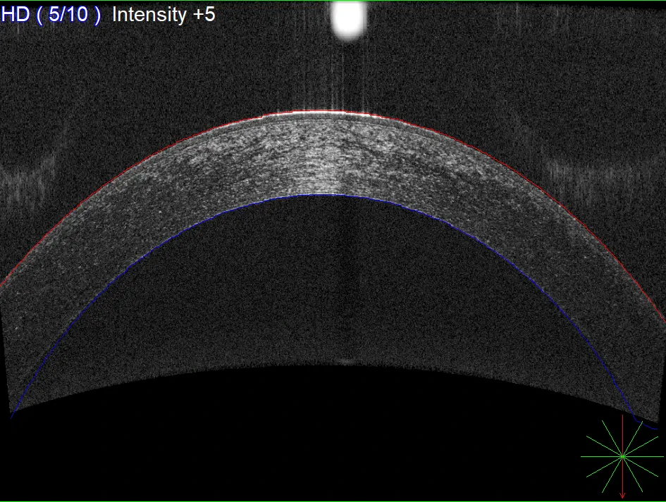 Pachymetry scan