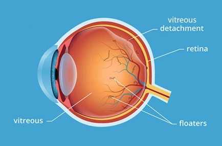Vitreous Detachment diagram - Fairlawn Eye Care Vitreous Detachment diagram