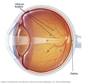 What Causes Floaterspng